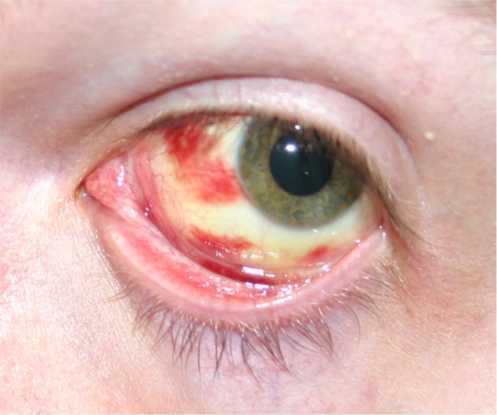 One Cause of Red Eye – Subconjunctival Hemorrhage