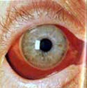 pink eye in infants #11